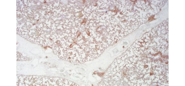 Tinción positiva (marrón) para PCV2 mediante inmunohistoquímica en pulmón de un cerdo con edema interlobular severo y neumonía intersticial difusa.
