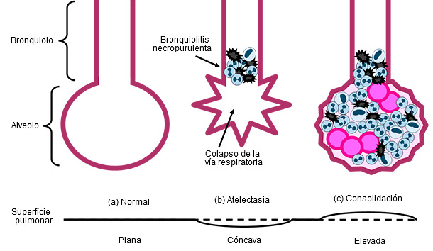 Bronquiolos