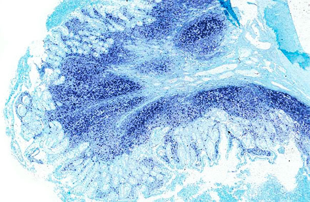 Íleon. El mismo íleon del cerdo afectado por enfermedad sistémica asociada a PCV2 presenta una gran cantidad de genoma de PCV2 en las placas de Peyer y en la mucosa intestinal. Hibridación in situ para detectar PCV2; colorante de contraste verde rápido.