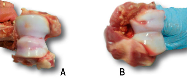 Osteocondrosis del cóndilo humeral 