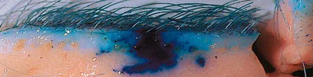 La tecnolog&iacute;a sin aguja mejora la dispersi&oacute;n de las vacunas en el tejido