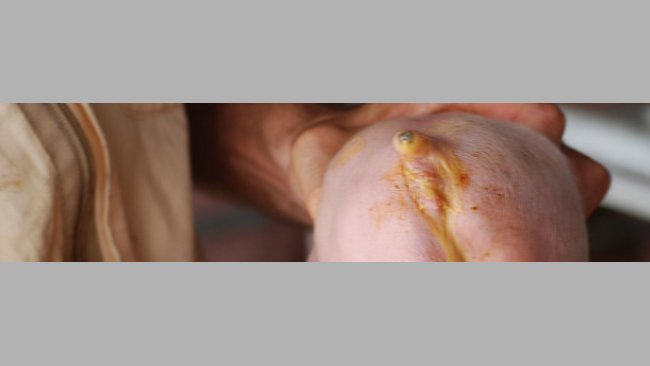 Diarrea neonatal causada por E. Coli. (Cortesía Dr Hector Patullo)