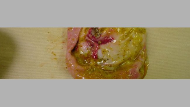 Úlcera en la zona pilórica