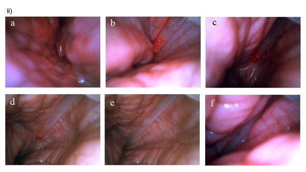Post-cervical insemination seen from inside the uterus