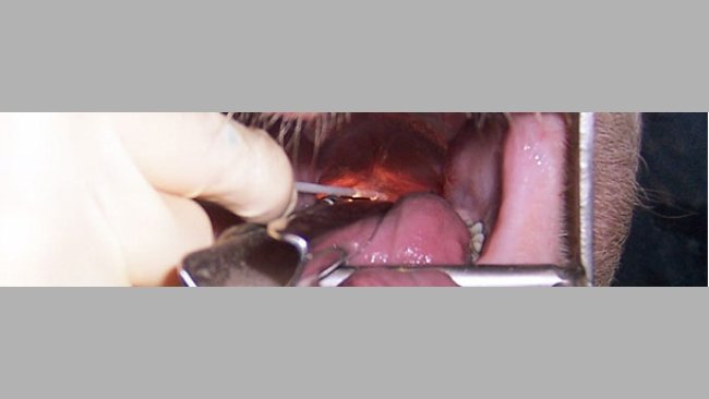 Laryngeal swab