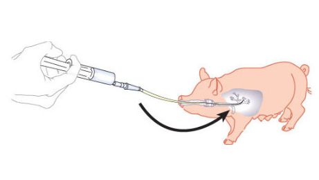 Sketch showing a bronchoalveolar lavage and bronchial scraping
