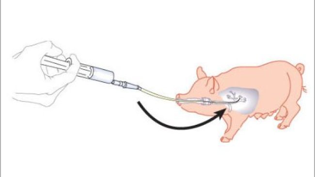 Sketch showing a bronchoalveolar lavage and bronchial scraping