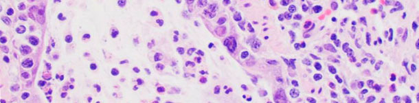 Microscopic lesions consistent with influenza infection include necrosis of the bronchiolar epithelium where the virus replicates
