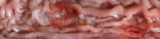 Zgrubiała śluz&oacute;wka dalszej części jelita cienkiego