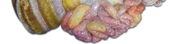 Obrzęk sieci i krezki jelit 