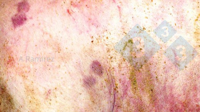 Fot. 1. Niemal patognomoniczna zmiana skórna w kształcie rombu.