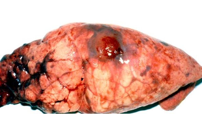 Chonic App lesion in the diaphragmatic lobe with pleuritc tags