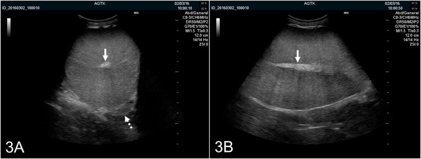 Figura 3:&nbsp;Imagens ultrasonogr&aacute;ficas do test&iacute;culo de um varrasco, ap&oacute;s recolha de s&eacute;men, transversalmente (A) e longitudinalmente (B). A rete testis &eacute; representada como uma mancha hiperecog&eacute;nica no centro do test&iacute;culo (seta s&oacute;lida). O par&ecirc;nquima testicular apresenta ecogenicidade m&eacute;dia e de ecotextura homog&eacute;nea. A imagem transversal tamb&eacute;m permite uma &oacute;ptima visualiza&ccedil;&atilde;o do corpo epididimal (seta ponteada), que &eacute; normalmente de apar&ecirc;ncia ultrasonogr&aacute;fica similar &agrave; do test&iacute;culo.
