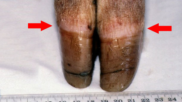 Figura 1. Borda coron&aacute;ria [seta]. Note-se o crescimento desigual e o in&iacute;cio do aparecimento de gretas na unha.
