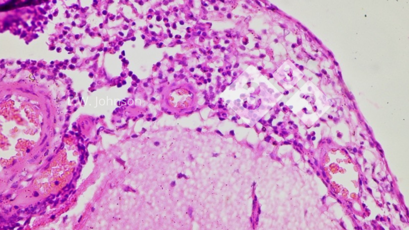 Imagem 3. Meningite com c&eacute;lulas mononucleares e algumas c&eacute;lulas polimorfonucleares. C&eacute;rebro.
