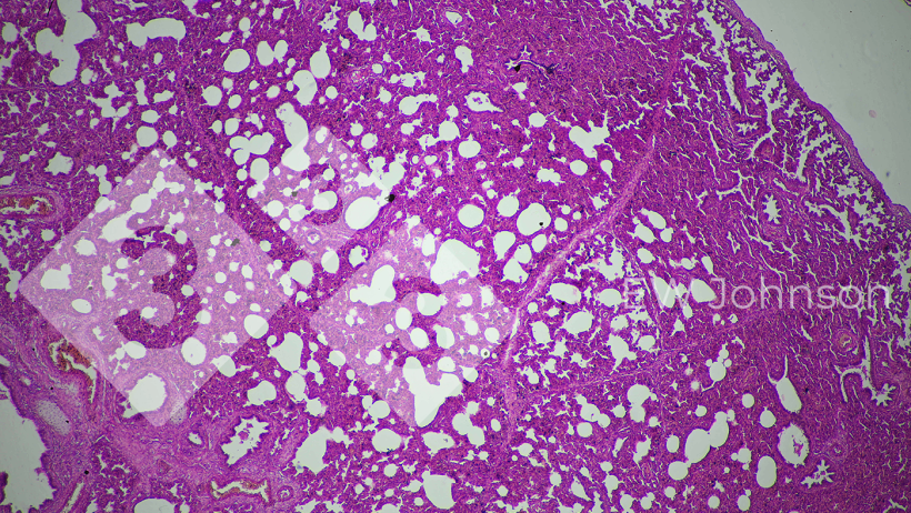 Figura 3. A pneumonia intersticial sugere uma possível origem viral.