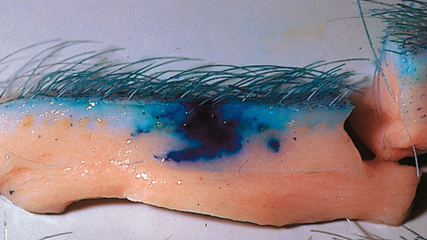 La tecnolog&iacute;a sin aguja mejora la dispersi&oacute;n de las vacunas en el tejido