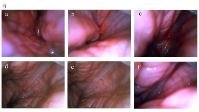 Post-cervical insemination seen from inside the uterus