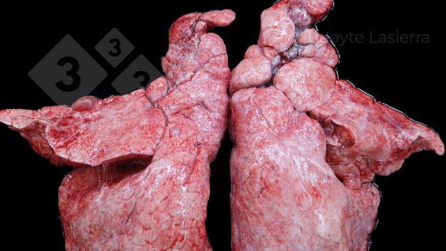 Vi&ecirc;m m&agrave;ng phổi v&ugrave;ng r&igrave;a
