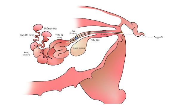 H&igrave;nh 2. Trong phối tinh sau cổ tử cung, tinh dịch được bơm v&agrave;o trong th&acirc;n tử cung, qua cổ tử cung.
