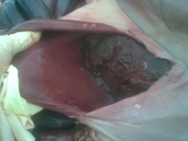 Ulcer